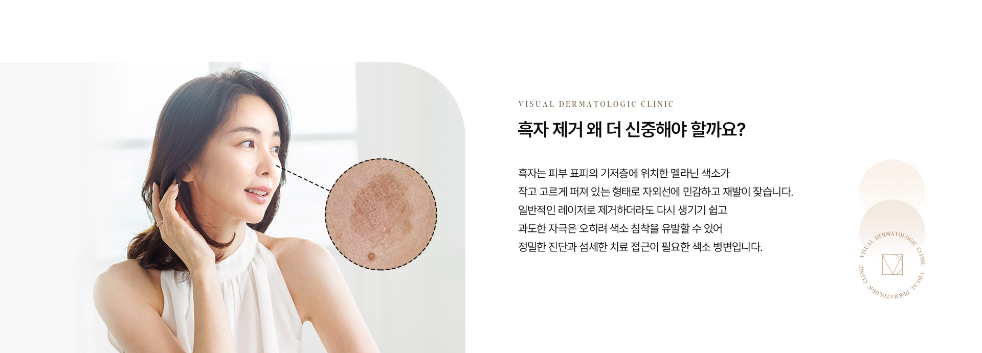 흑자검버섯 02