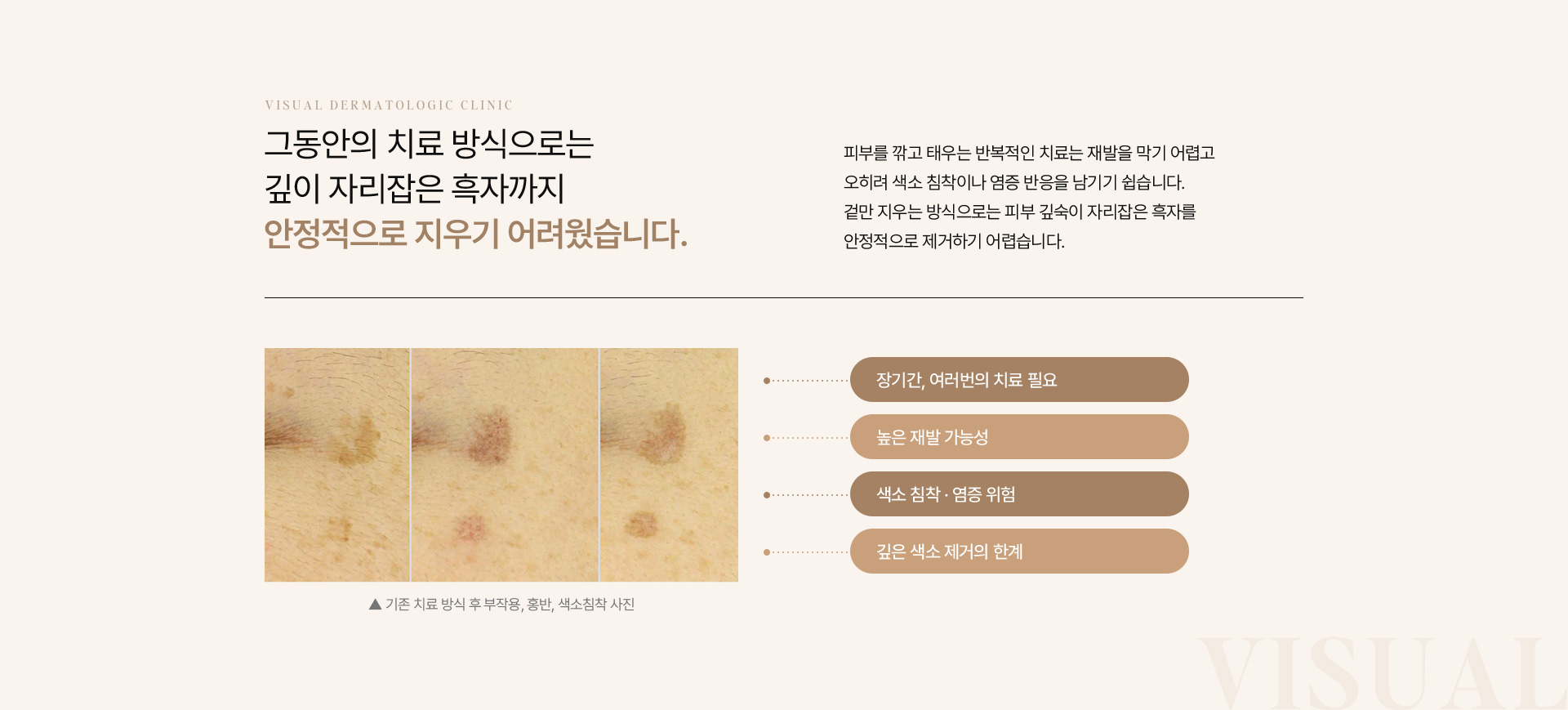 흑자검버섯 07