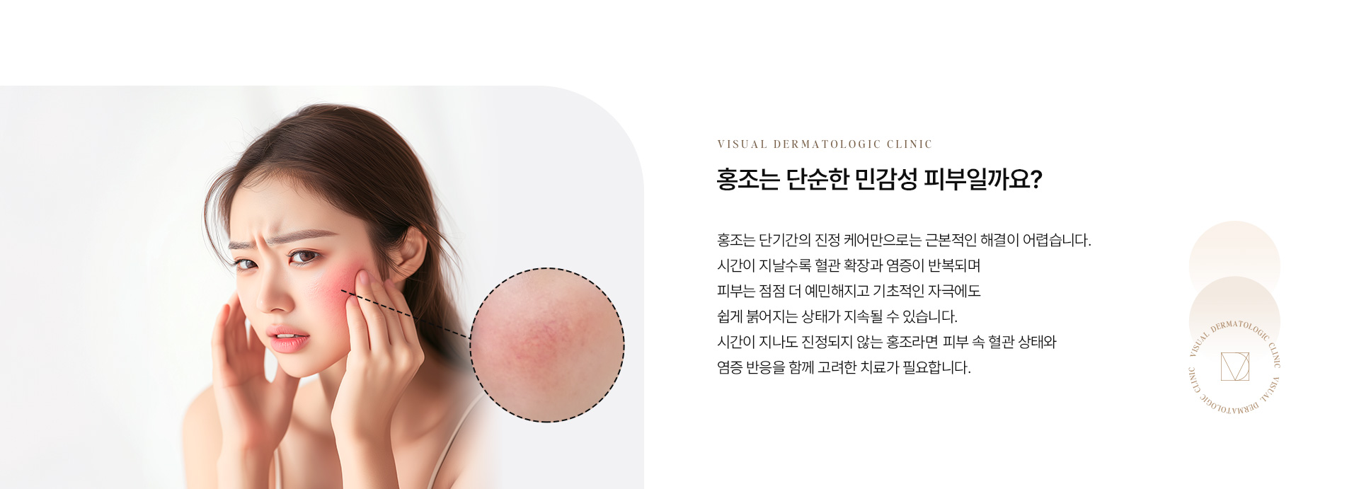 홍조 02