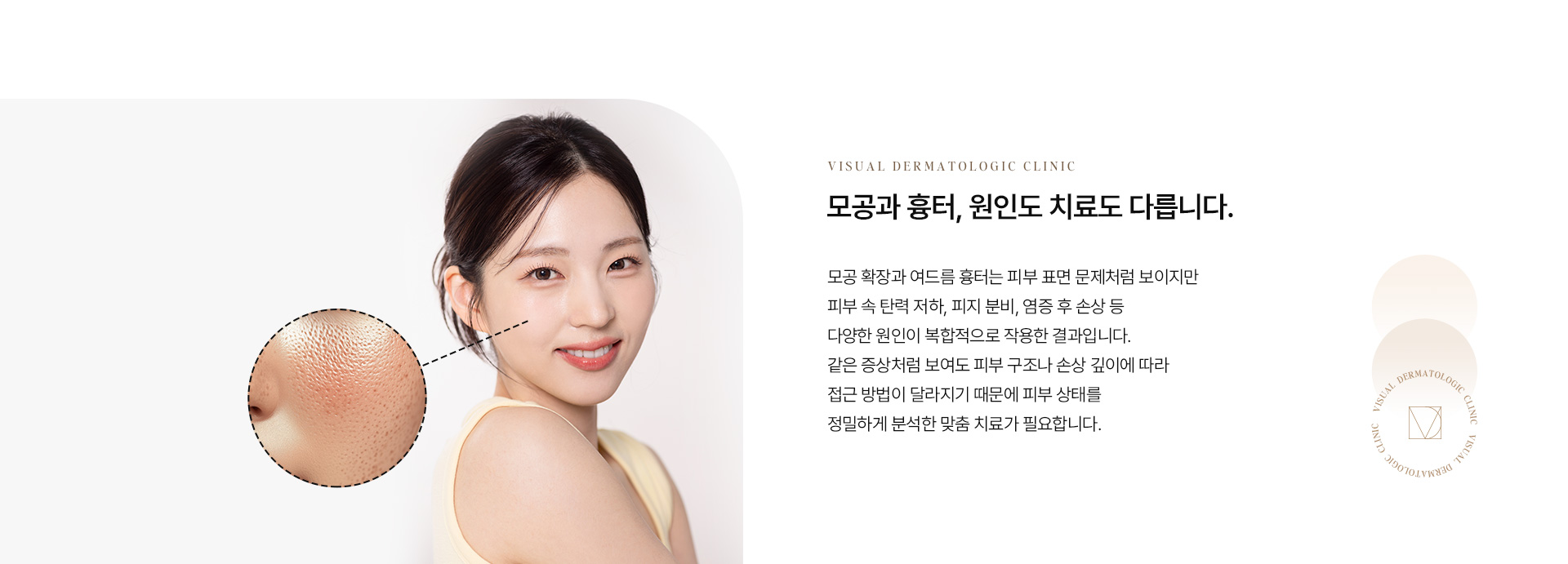 모공흉터 02
