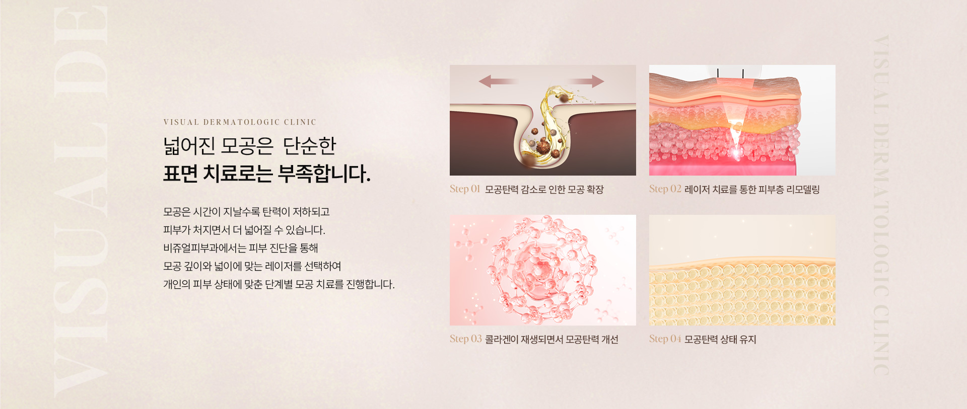 모공흉터 09