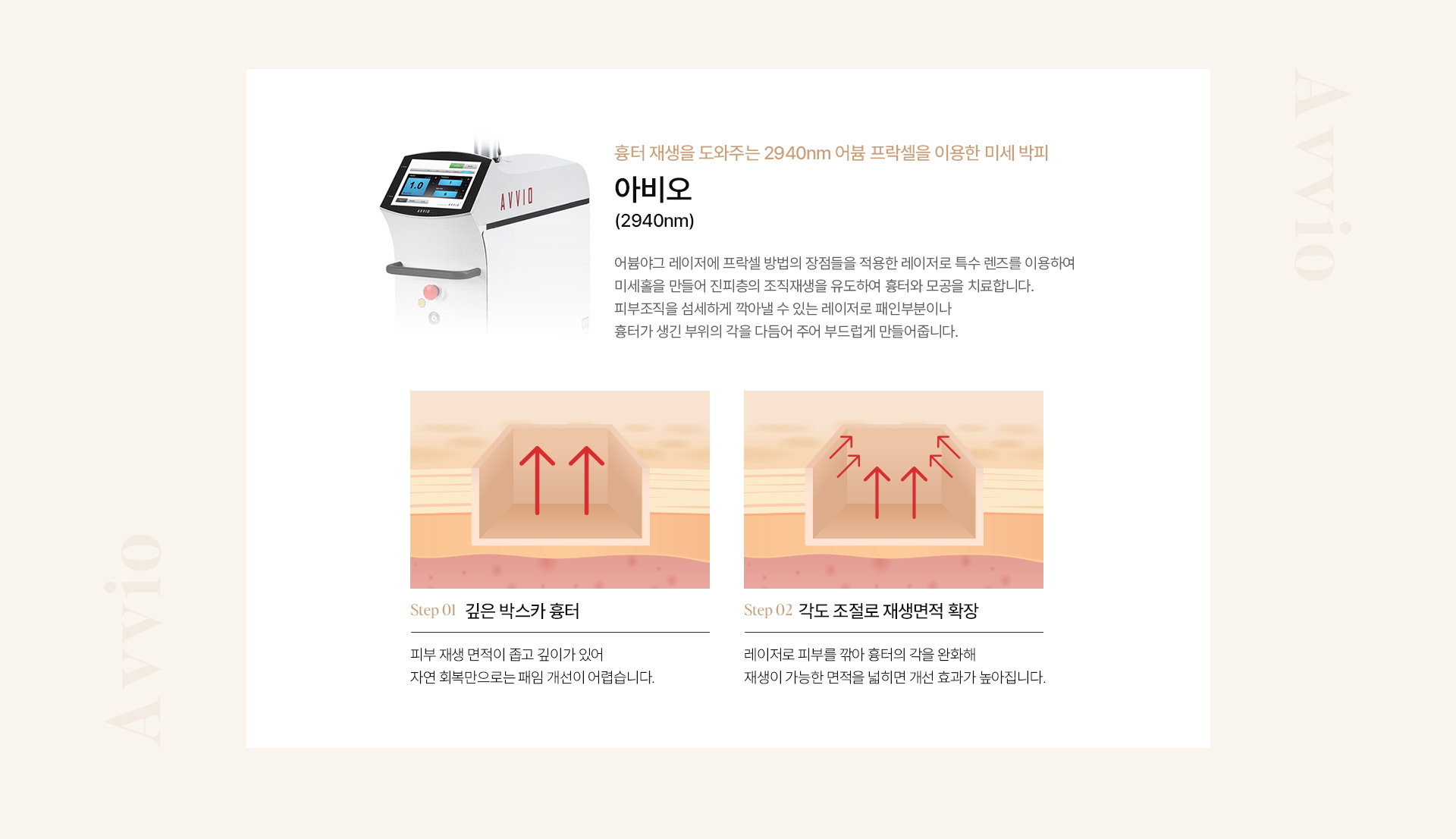모공흉터 10