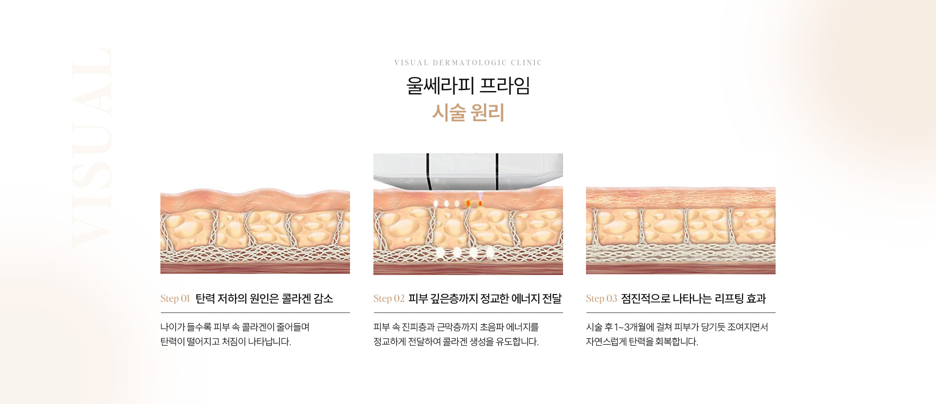 울쎄라피 12